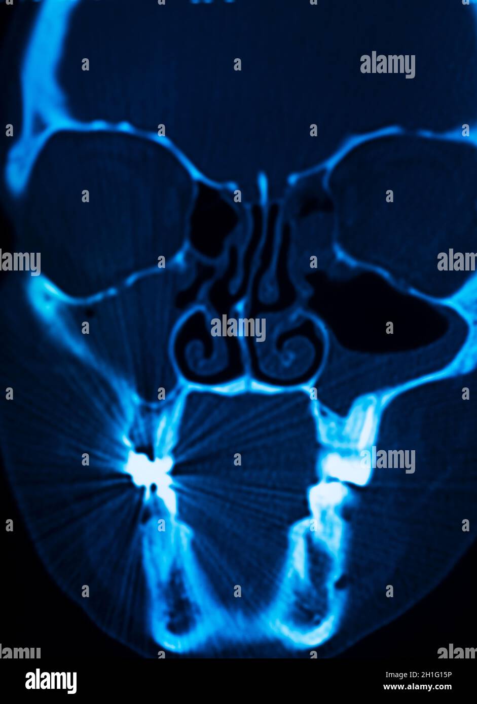 Nasal fracture -Fotos und -Bildmaterial in hoher Auflsung  Alamy