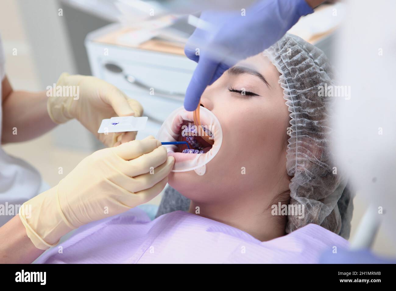Professionelle Zahnreinigung. Der Zahnarzt trägt vor der Reinigung ein violettes Gel auf die Zähne des Patienten auf. Speichelpumpe im Mund. Vermeidung von Kari Stockfoto