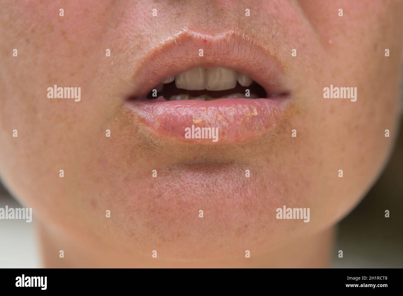 In der Nähe der weiblichen Lippen Herpes Krankheit leiden. Stockfoto