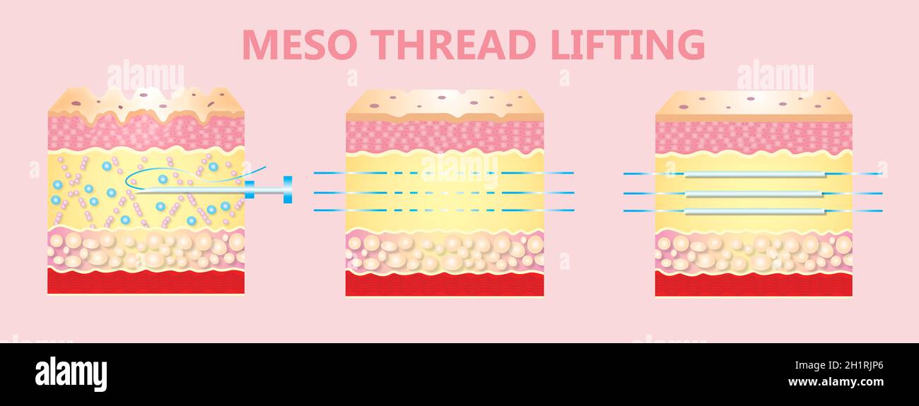 Meso-Gewinde anheben. Junge und alte Haut. Konzept für das Heben durch Gewinde. Vektorgrafik Stockfoto