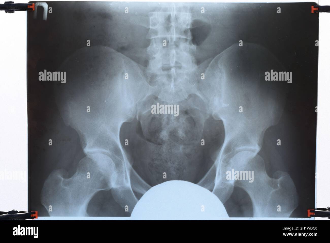 X-ray von Becken und Kreuzbein. X-ray Image. Stockfoto
