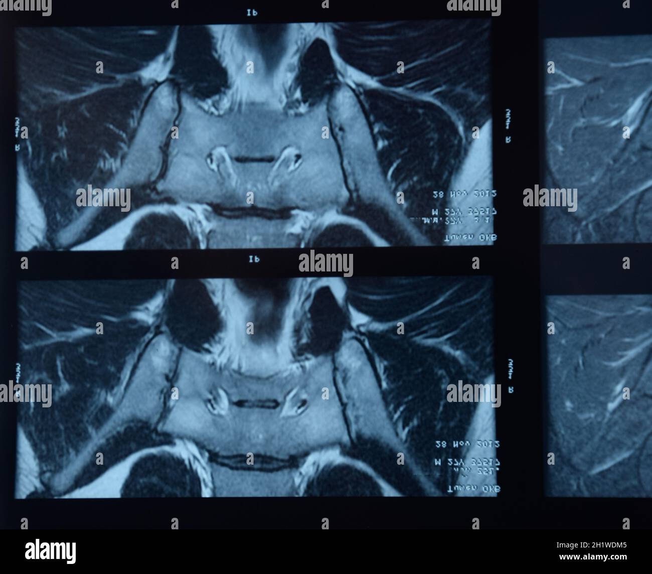 MRI sacroiliac Artikulation. Studie der ankylosierenden spondyloarthritis Patienten. Die Ergebnisse der Studie über die x-ray. Stockfoto