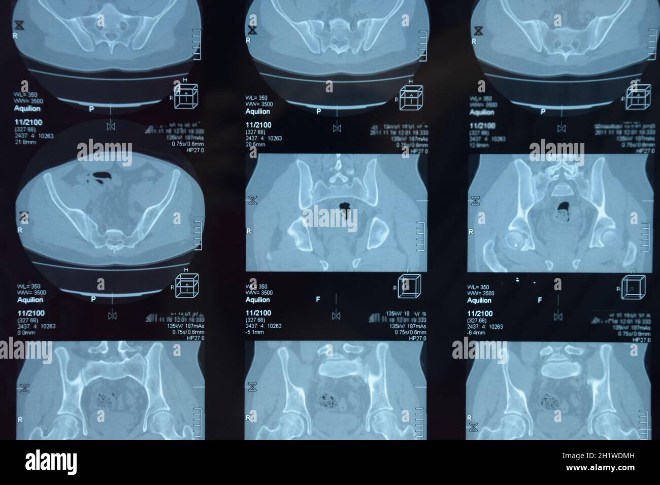 MRI sacroiliac Artikulation. Studie der ankylosierenden spondyloarthritis Patienten. Die Ergebnisse der Studie über die x-ray. Stockfoto