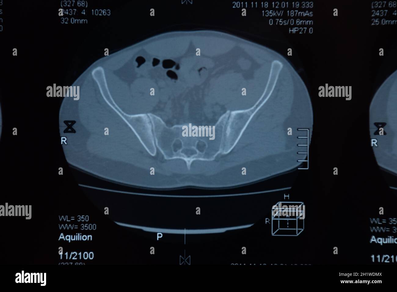 MRI sacroiliac Artikulation. Studie der ankylosierenden spondyloarthritis Patienten. Die Ergebnisse der Studie über die x-ray. Stockfoto