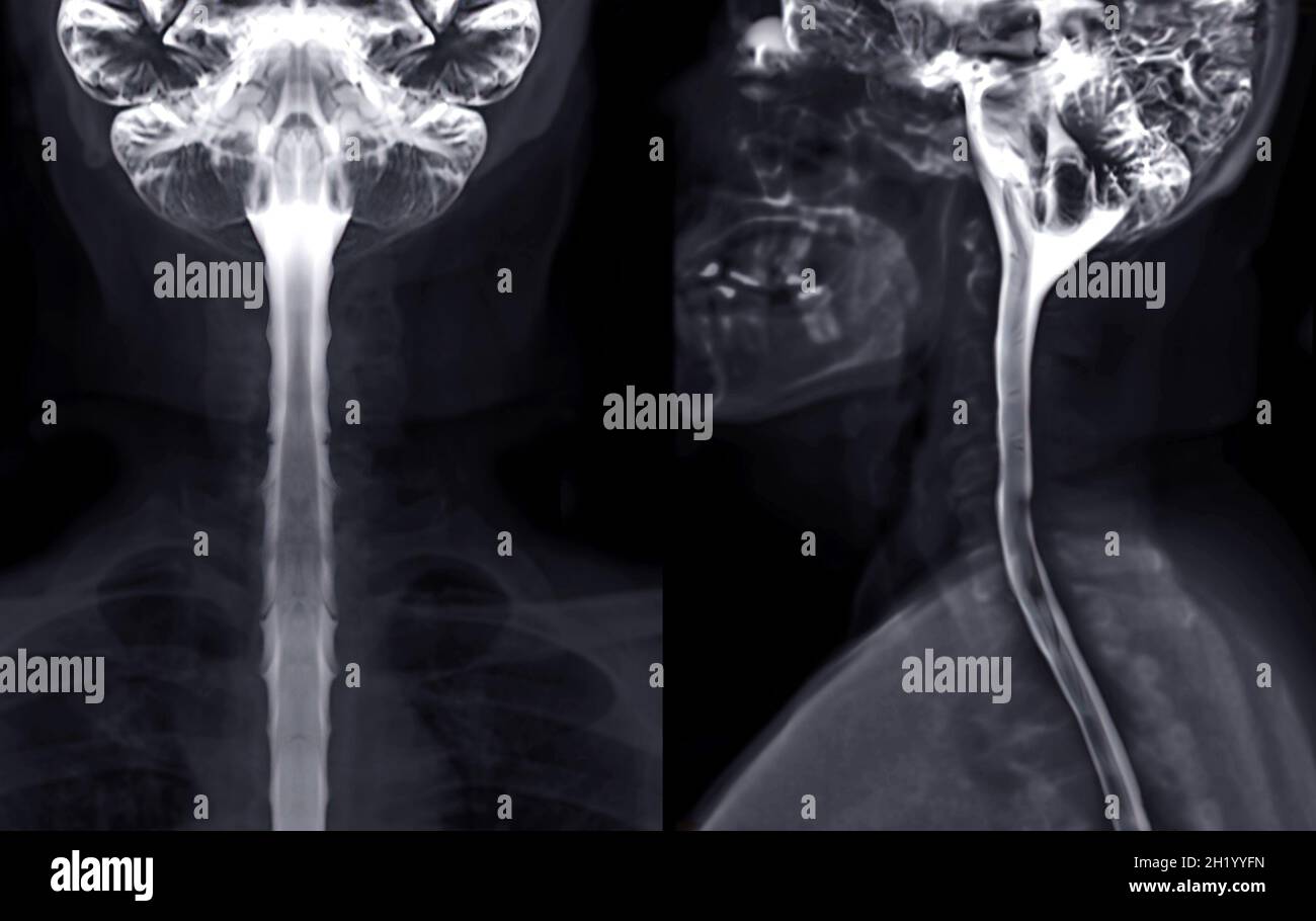 MRT-Untersuchung des Myelogramms der Halswirbelsäule zur diagnostischen Wirbelsäulenkompression. Stockfoto