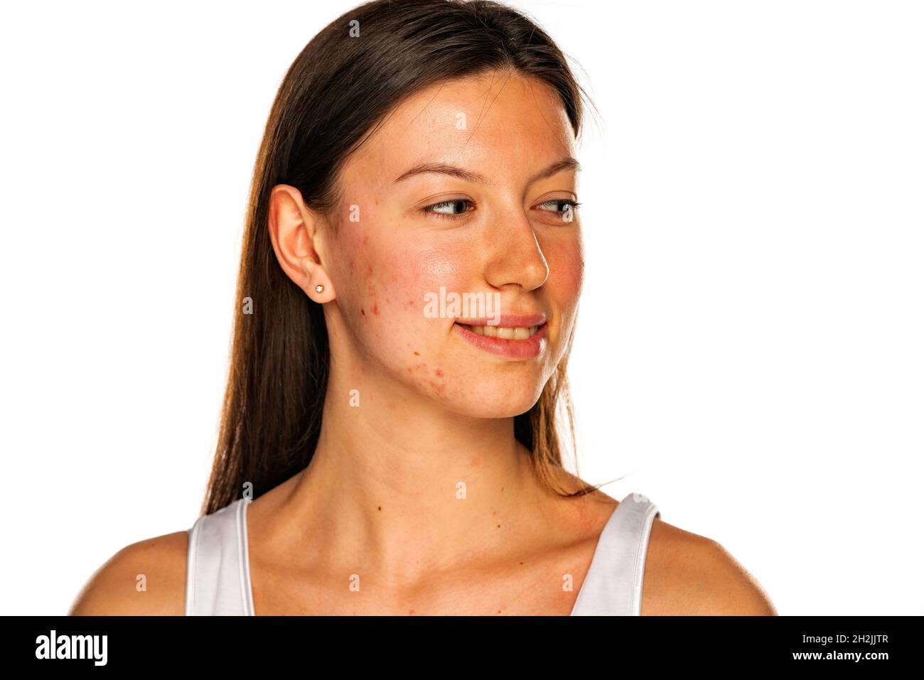 Schöne lächelnde Frau ohne Make-up und problematische Haut, die auf einem weißen Hintergrund zur Seite schaut Stockfoto