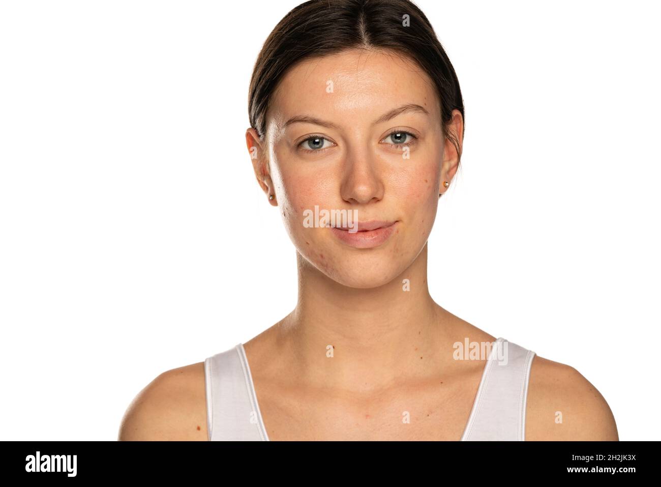 Schöne lächelnde Frau ohne Make-up und problematische Haut auf weißem Hintergrund Stockfoto