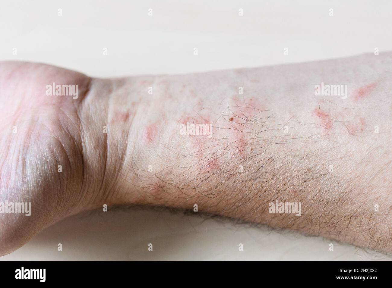 Probe der allergischen Kontaktdermatitis - Hautausschlag auf der Innenseite des Unterarms aus nächster Nähe Stockfoto