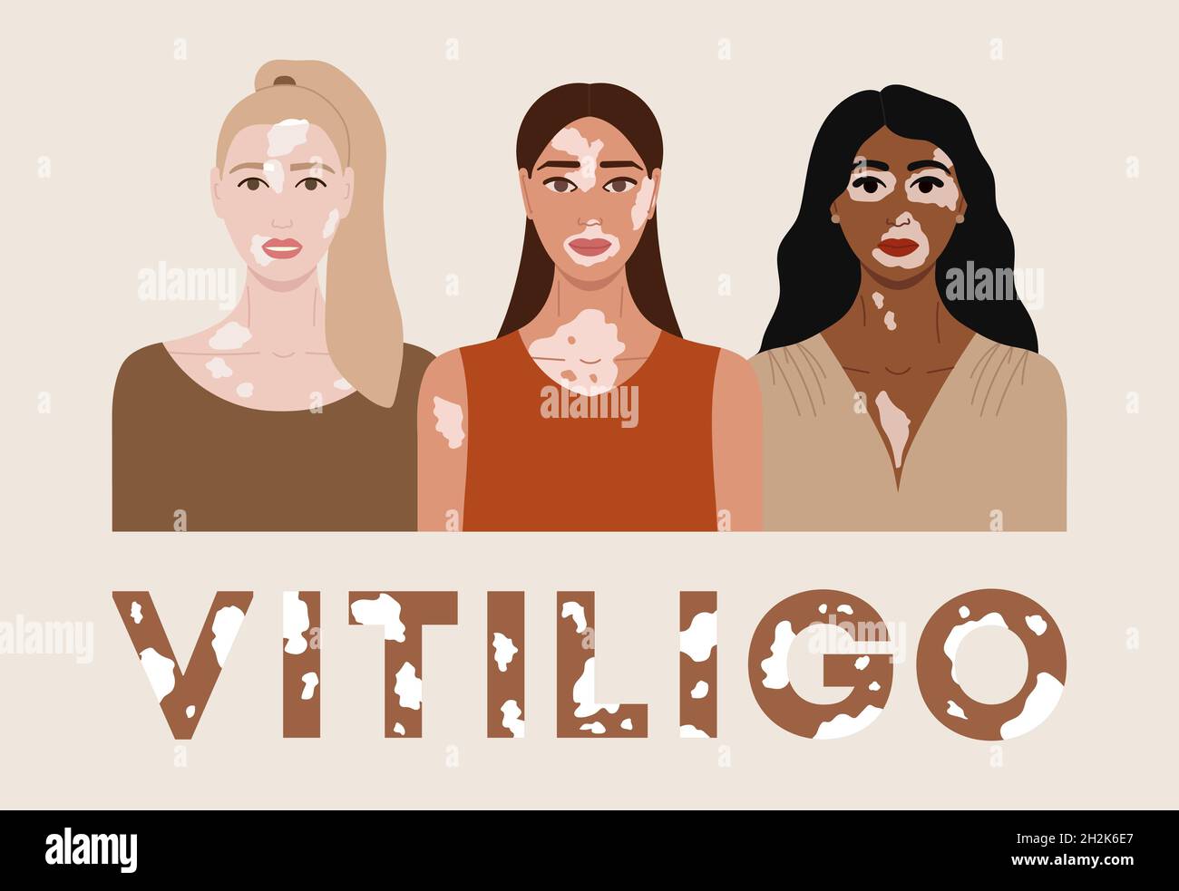 Set von weiblichen Gesichtern mit Vitiligo. Poster zum Welt-Vitiligo-Tag. Sammlung von Porträts von Frauen mit verschiedenen Hautfarben und Frisuren. Körper positiv Stock Vektor