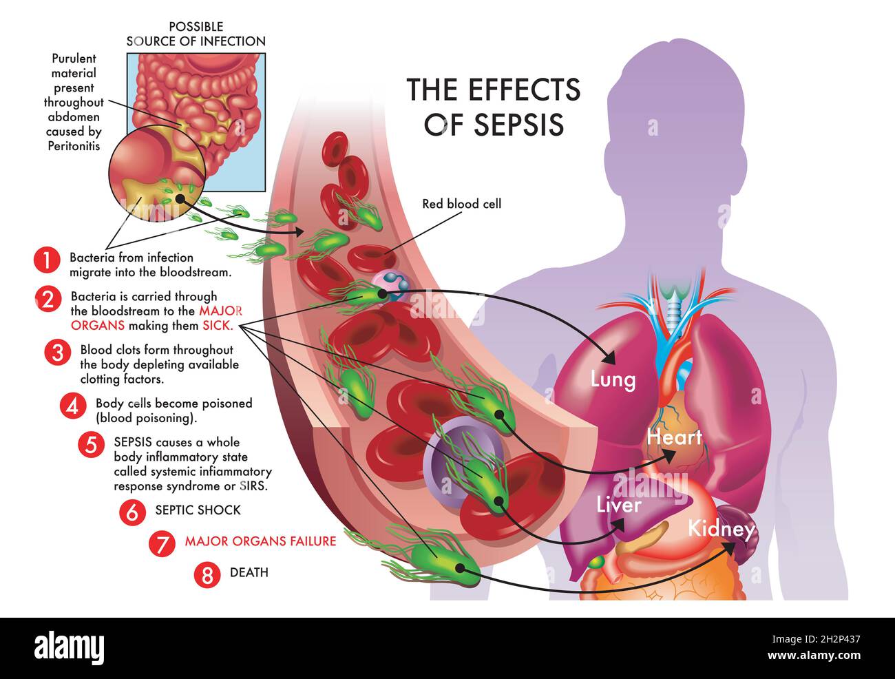 Medizinische Illustration der Auswirkungen der Sepsis. Stockfoto