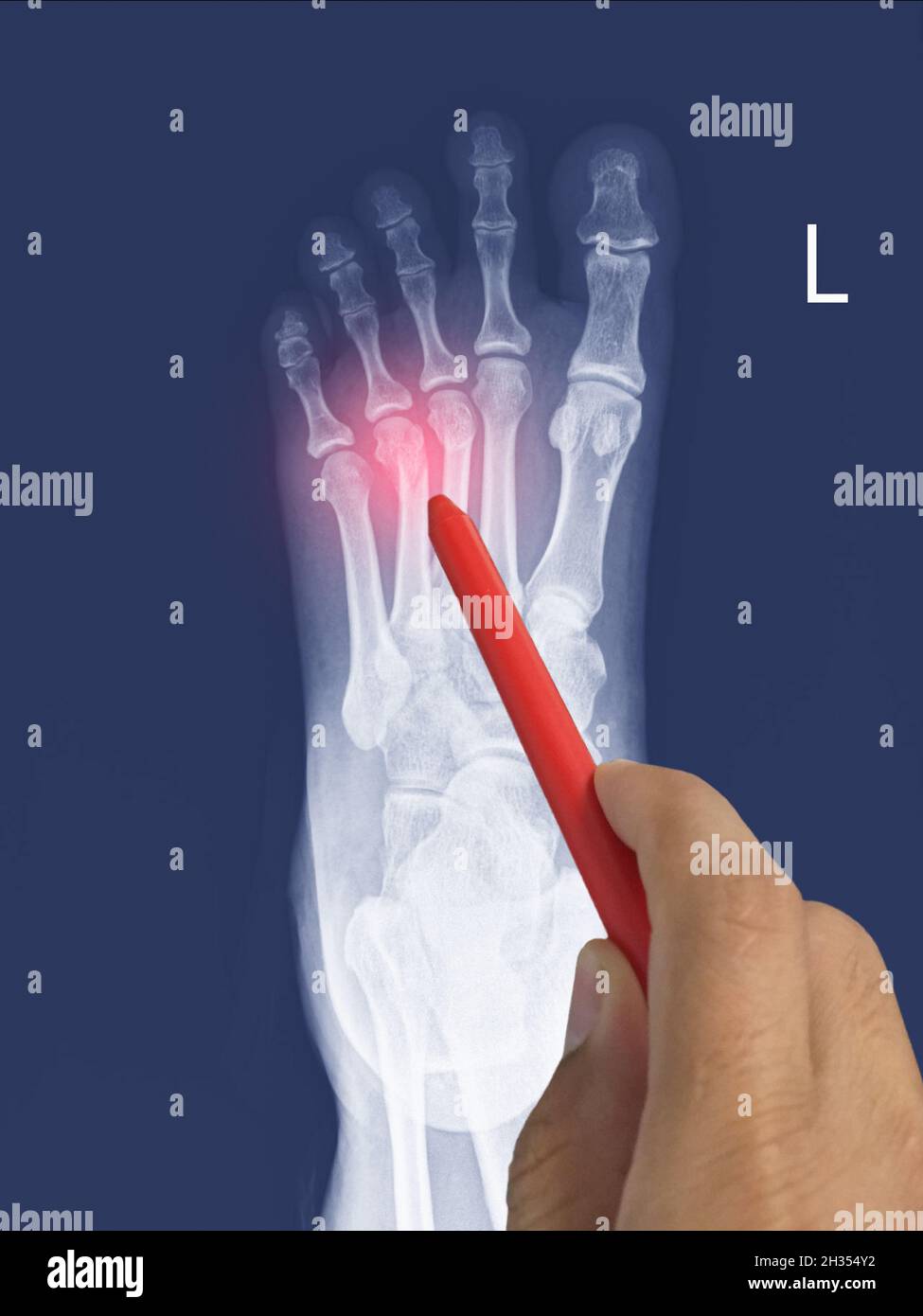 Nahaufnahme Röntgenfuß AP zeigt Bruch 3.,4. Metatarsalknochen, Arzt hält einen roten Stift Punkt , Symptome medizinisches Gesundheitskonzept. Stockfoto