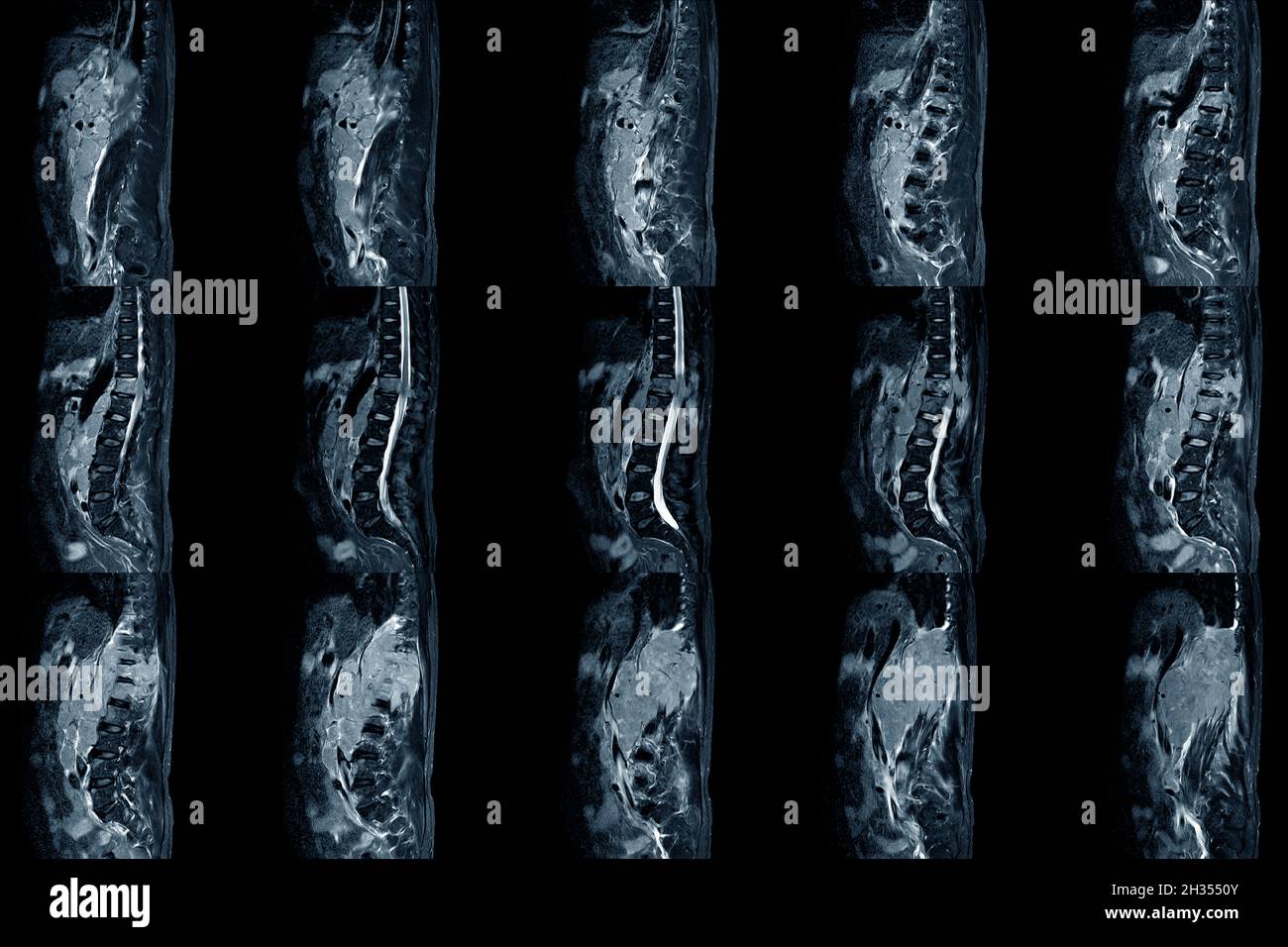 Lumbale Spinalstenose MRT-Untersuchung Sagittalansicht bei mittelschwerer posteriorer inferiorer Tumorvorwölbung wird eine beidseitige Wurzelkompression verursacht. Chronischer niedriger Rücken Stockfoto