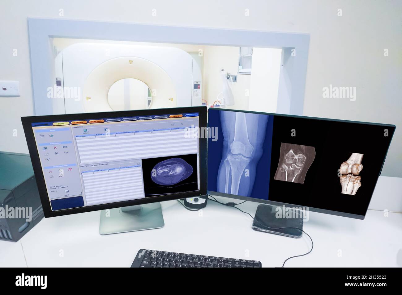 Nahaufnahme Computermonitor Scan Kontrollraum und Computer zeigen Kniescan Bruch, Medizintechnikkonzept Stockfoto