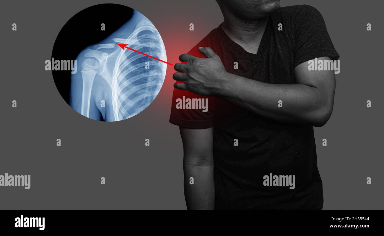 Schlüsselbein scapula Fotos und Bildmaterial in