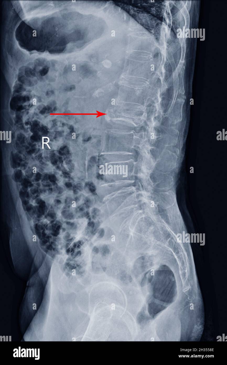Film X-ray LS-Wirbelsäule Seitenansicht zeigt Burst Fracture des L2-Wirbelkörpers mit schwerem Wirbelkollaps, medizinisches Bildkonzept. Stockfoto