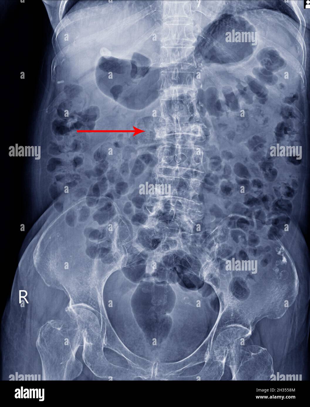 Film X-ray LS-Wirbelsäule AP-Ansicht zeigt Burst Fracture des L2-Wirbelkörpers mit schwerem Wirbelkollaps, medizinisches Bildkonzept. Stockfoto