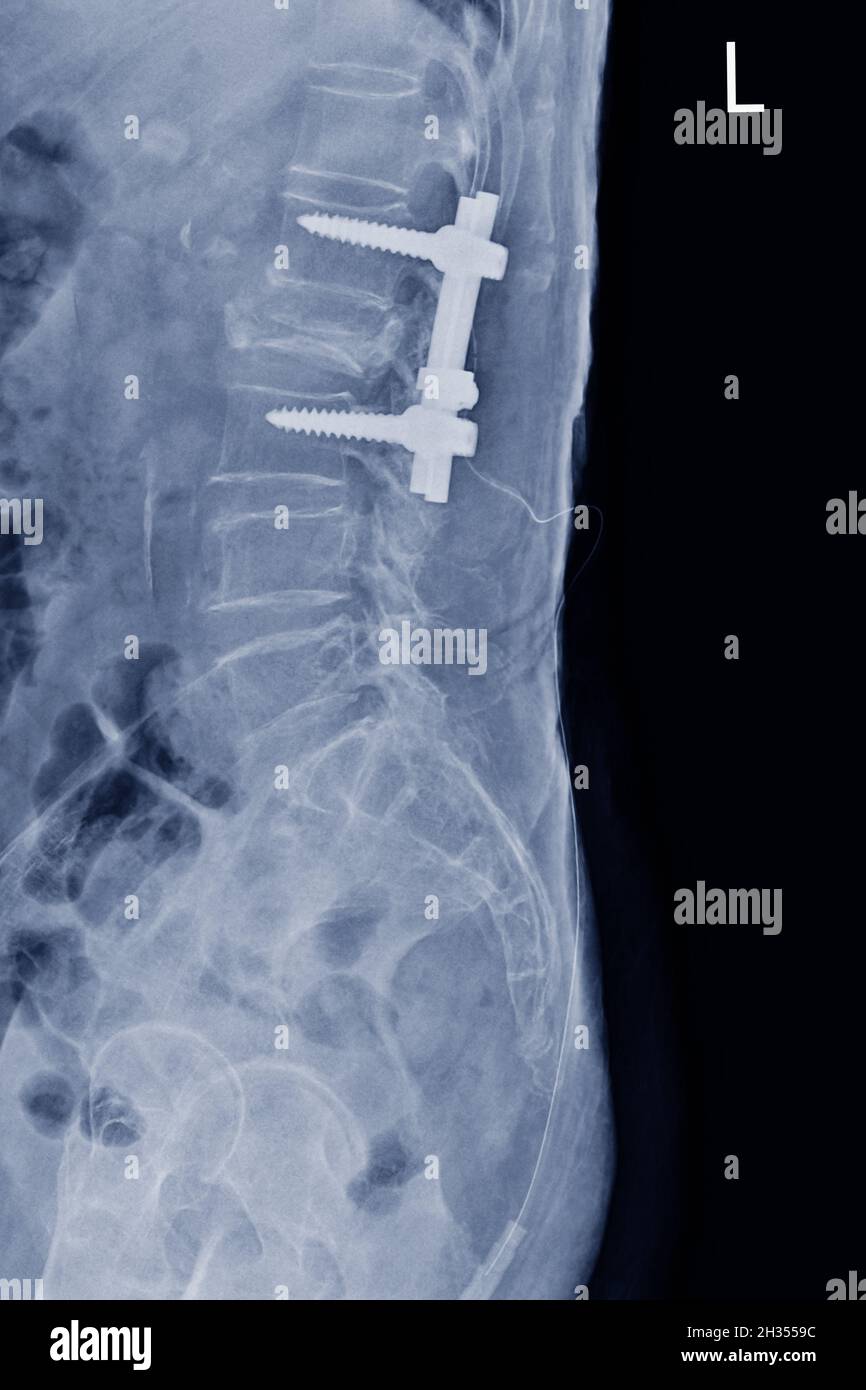 Film X-ray LS-Wirbelsäule Seitenansicht zeigt Burst Fracture des L2 Wirbelkörpers mit Post-Operation-Platte und Schraube, medizinisches Bildkonzept. Stockfoto