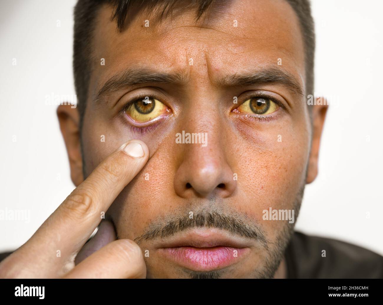Mann mit gelblichen Augen und Haut. Lebererkrankung. Hohes Bilirubin, Gelbsucht, Hepatitis, Zirrhose, Leberversagen Stockfoto