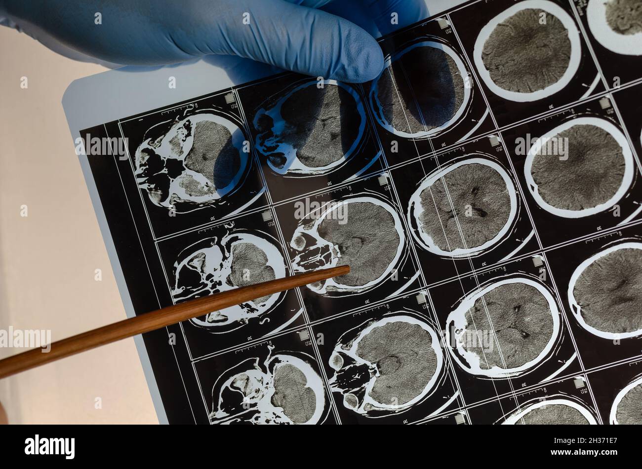 Arzt mit blauen medizinischen Handschuhen zeigt einen Zeiger auf eine Röntgenaufnahme des Gehirns einer Person. Gesundheit und Medizin. Selektiver Fokus. Stockfoto
