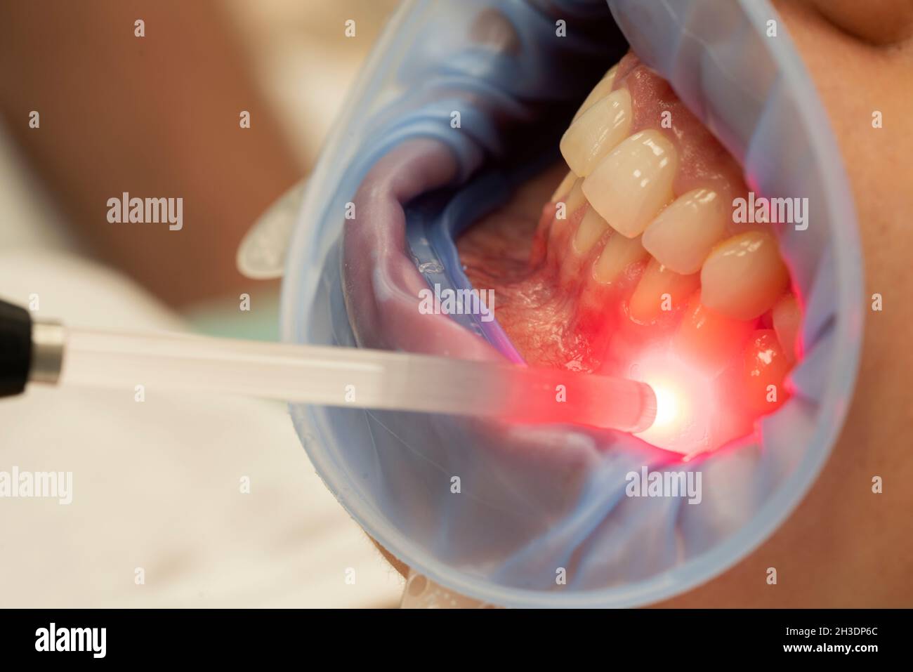 Zahntherapie mit rotem LED-Licht in der Zahnarztpraxis Stockfoto