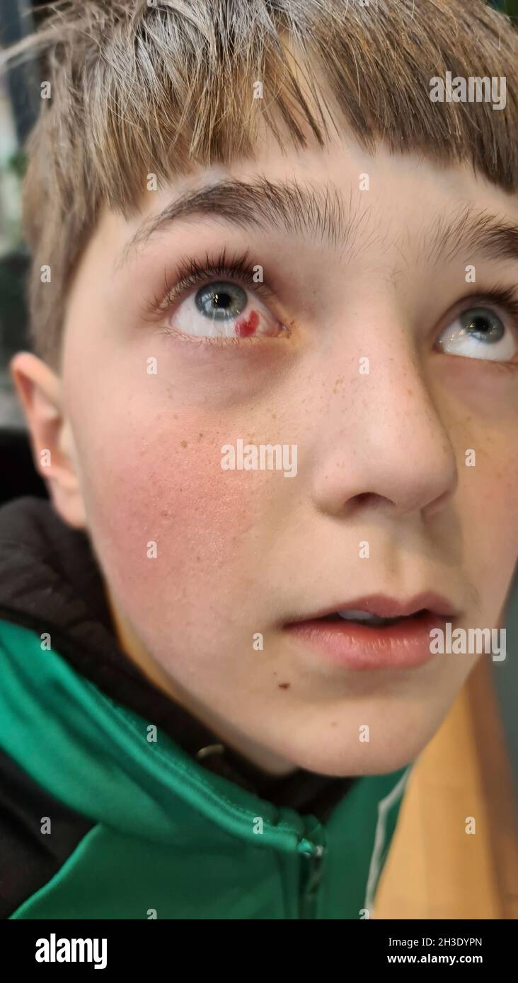 Junge mit zerplatzten kleinen Blutgefäßen in einem Auge, durchgesickert Blut Stockfoto