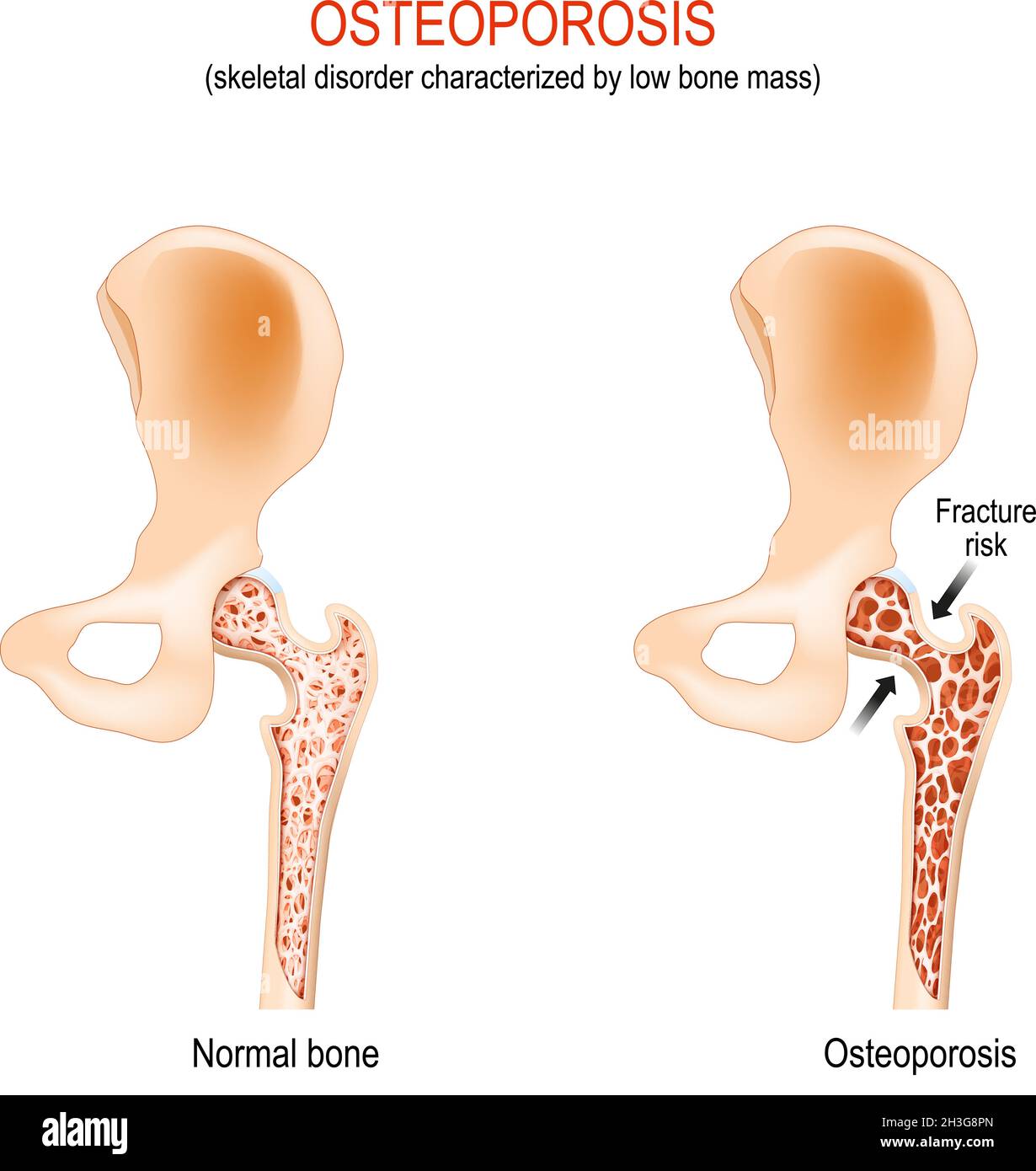 Osteoporose. Normales Hüftgelenk und Knochen mit Skelettstörung, die durch geringe Knochenmasse gekennzeichnet ist. Femurfrakturrisiko. Differenz und Vergleich Stock Vektor