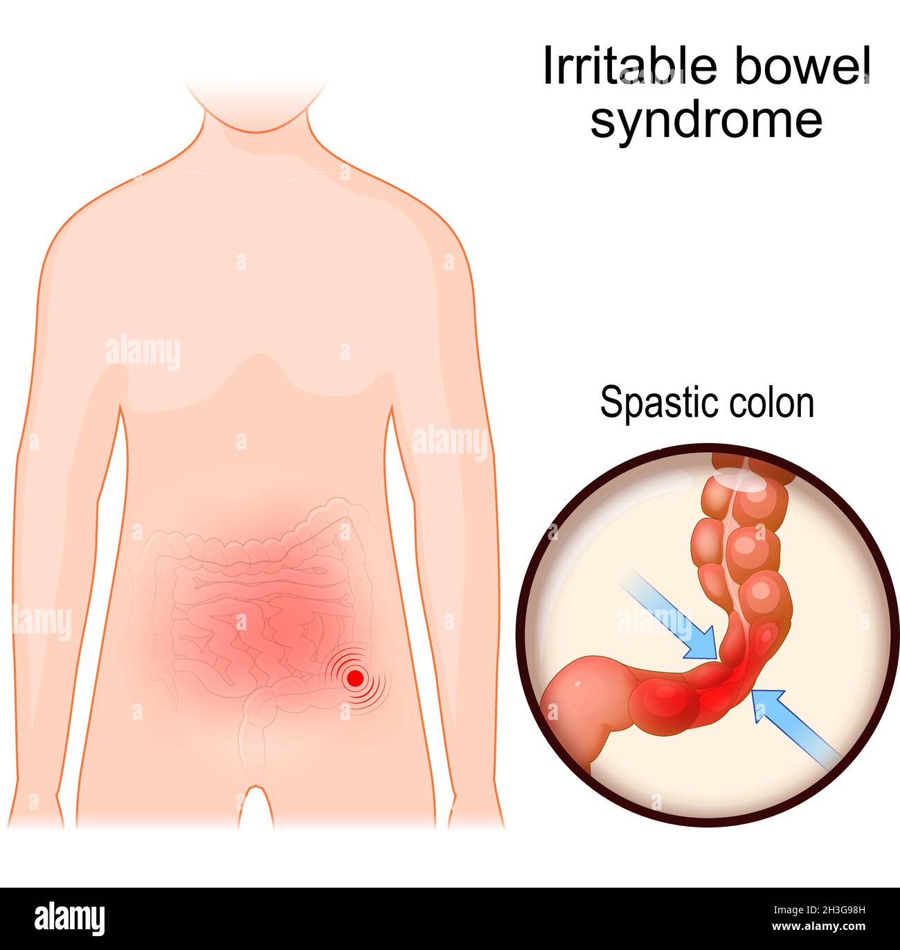 Reizdarmsyndrom. IBS oder Schleimkolitis ist eine funktionelle Magen-Darm-Erkrankung. Körper des Menschen mit Bauchschmerzen Bereiche Stock Vektor