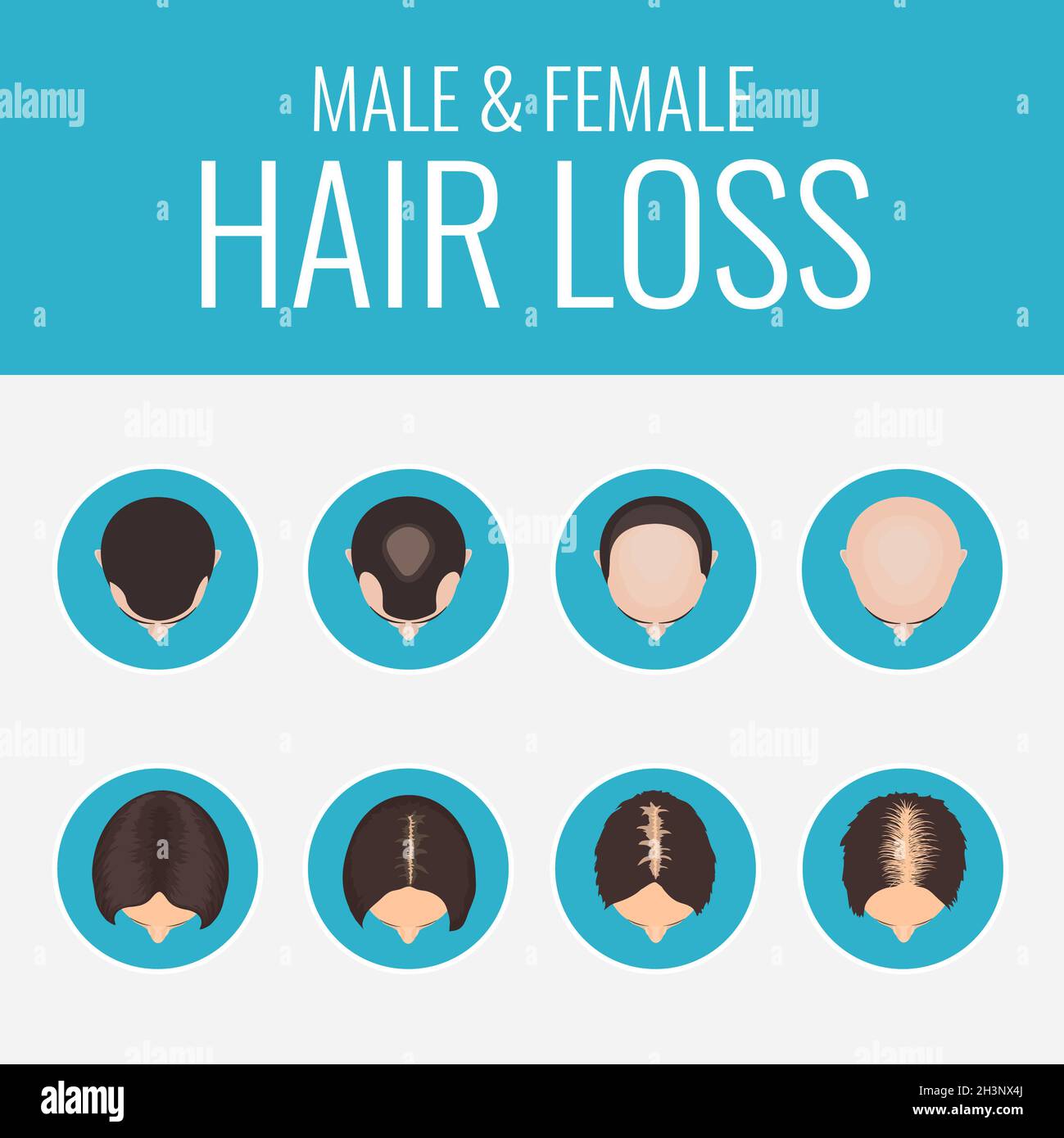 Weibliche und männliche Muster Alopezie, Illustration Stockfoto