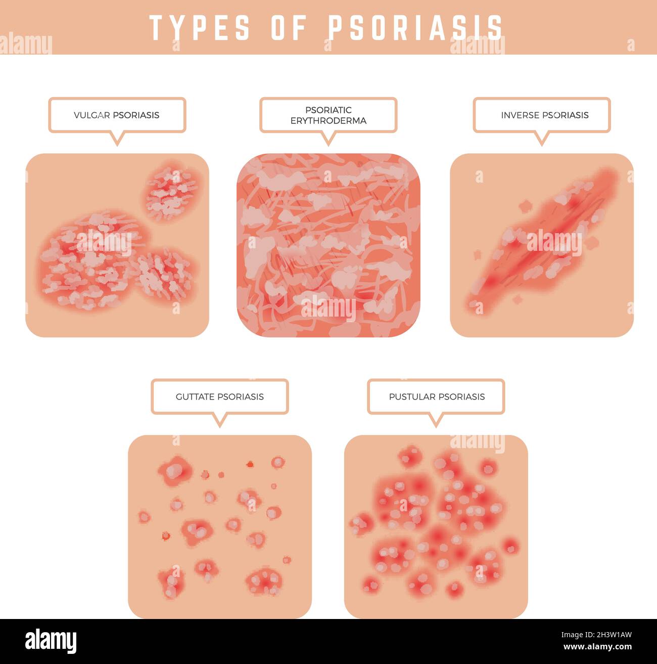 Psoriasis-Typen. Hautprobleme Nahaufnahme medizinische Illustrationen Vektor-Set Stock Vektor