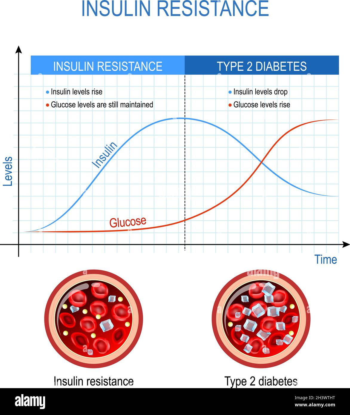 Insulinresistenz und Typ-2-Diabetes. Vergleich und Unterschied. Hoher Blutzucker. Tabelle mit Insulin- und Glukosespiegel. Querschnitt des Blutes Stock Vektor