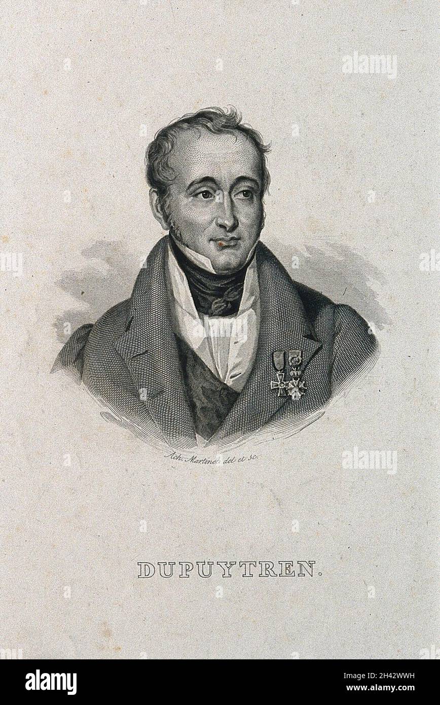 Guillaume, Baron Dupuytren. Linienstich von A. Martinet nach sich selbst. Stockfoto