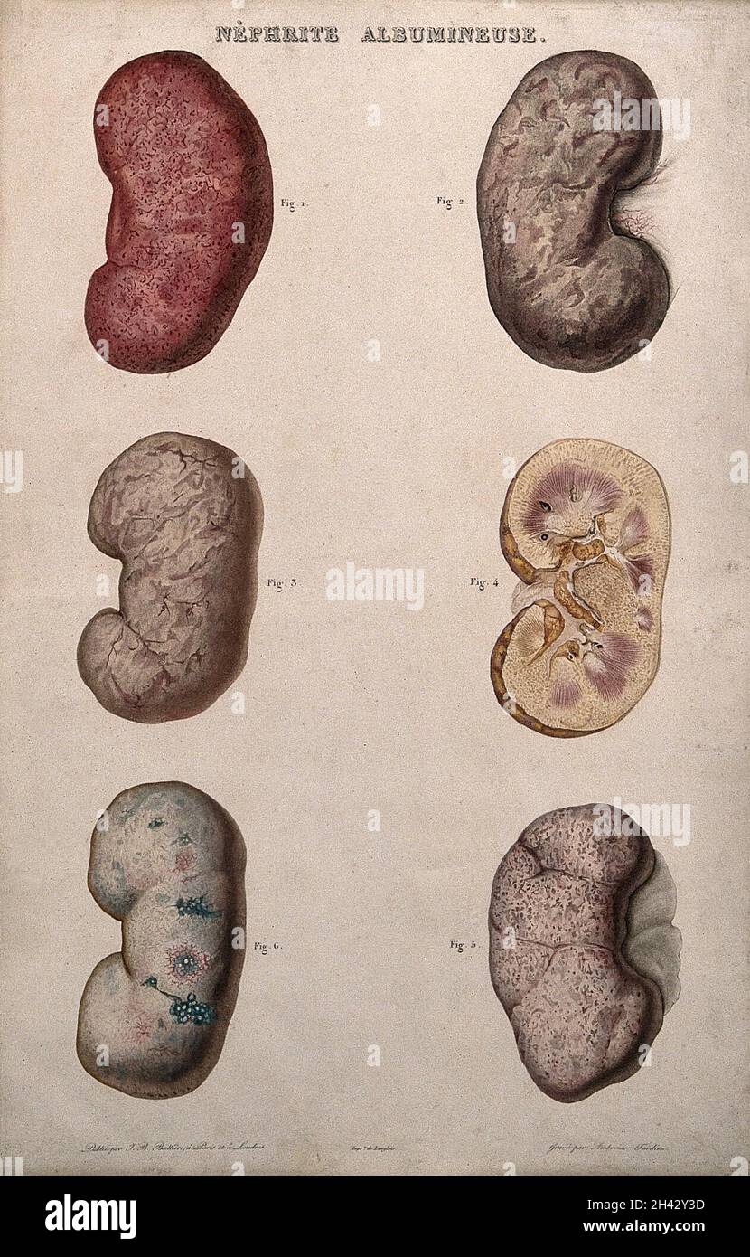 Mehrere Beispiele für erkrankte Nieren, nummeriert für Schlüssel. Farbradierung von Ambroise Tardieu für Rayer. Stockfoto