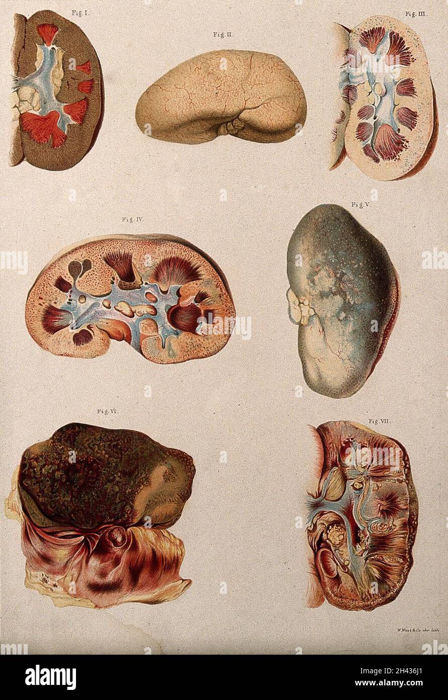 Erkrankte Nieren: Sieben Beispiele. Chromolithograph, 1877/1899? Stockfoto