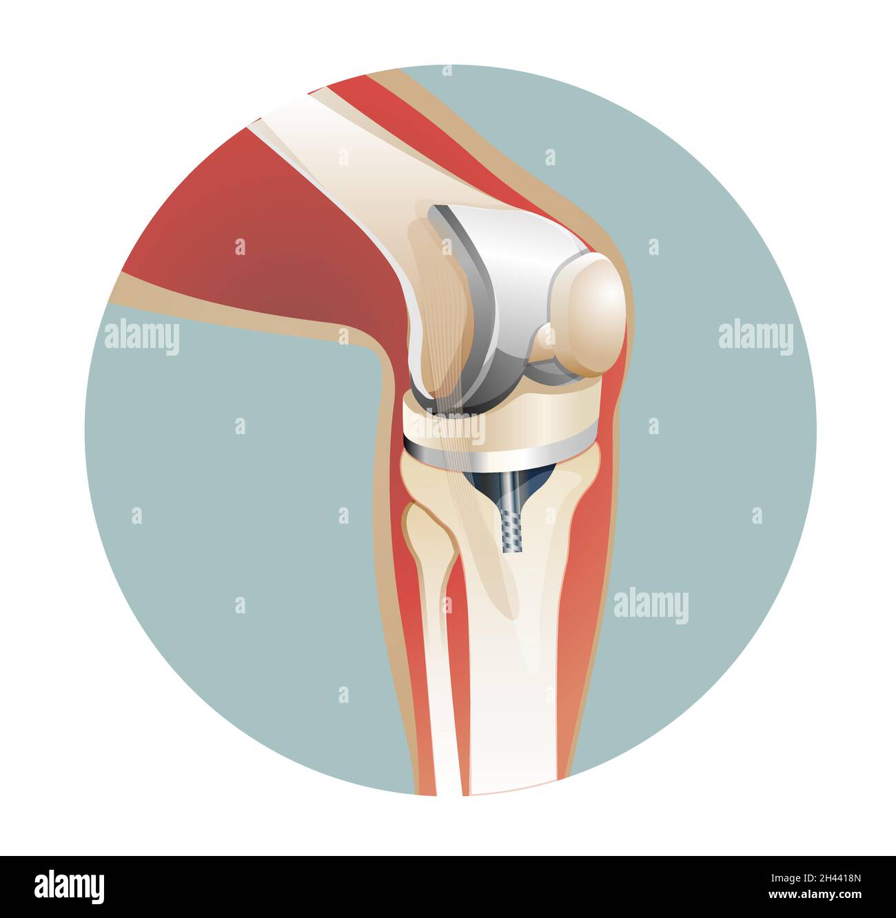 Kniegelenkersatz-Chirurgie - Illustration als EPS 10-Datei Stock Vektor