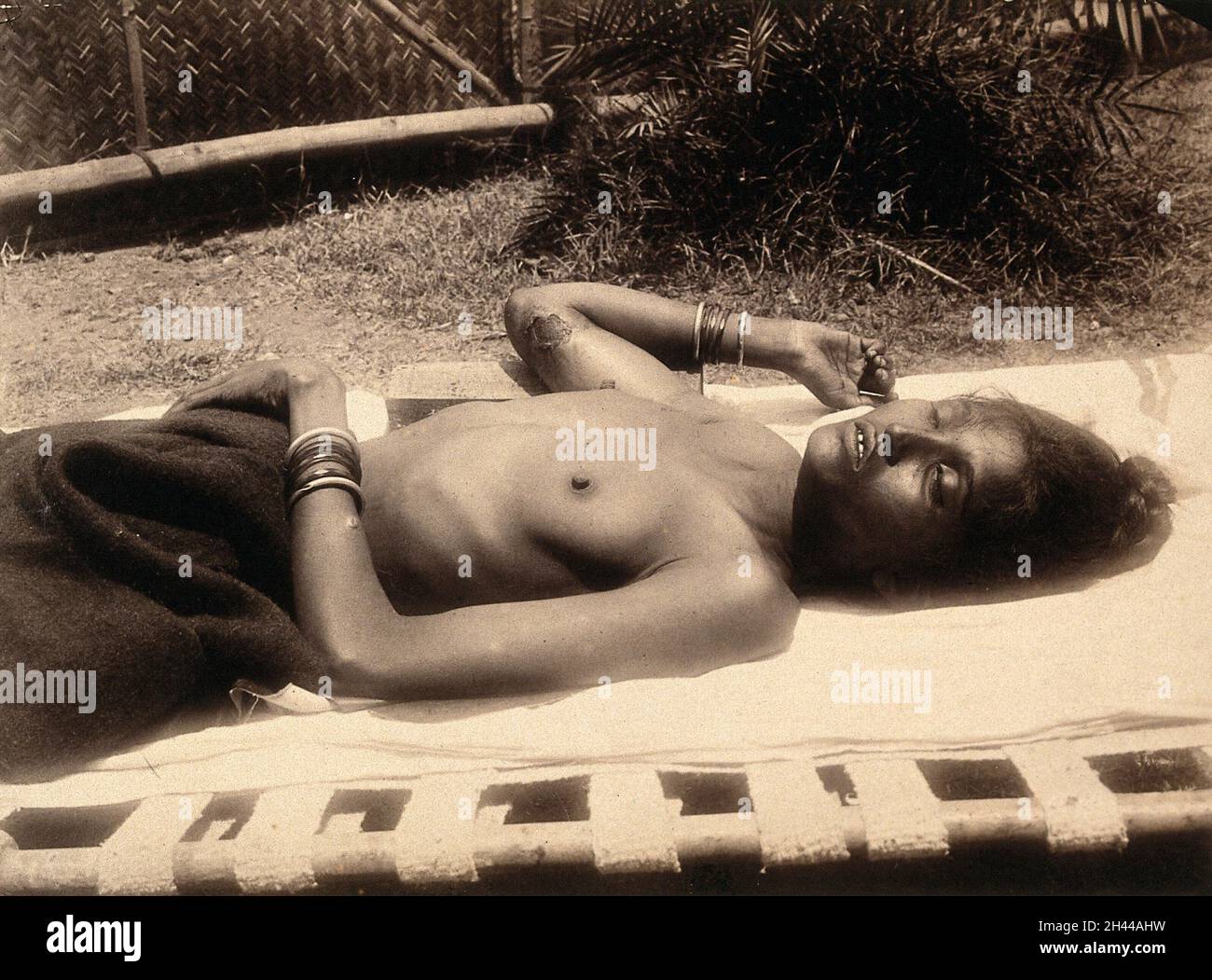 Eine Inderin, ein Opfer der Pest, liegt auf einer Bahre im Sonnenschein. Foto, ca. 1896. Stockfoto