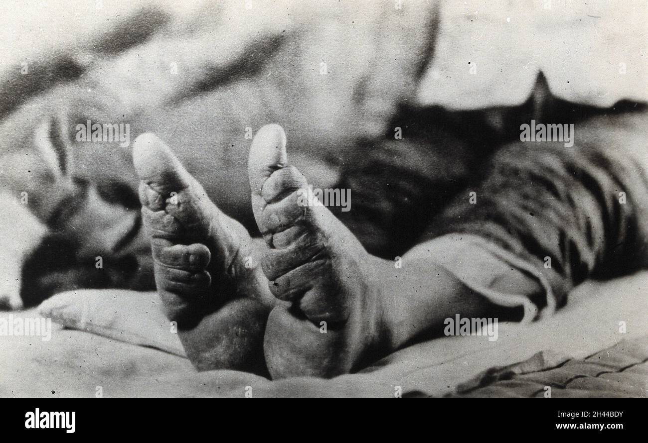 Füße einer chinesischen Frau, die die Wirkung der Fußbindung zeigt. Foto, 19--. Stockfoto