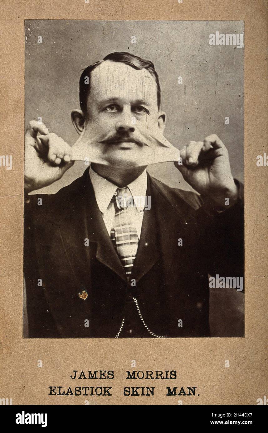 James Morris, der die Haut auf seinem Gesicht streckt. Foto. Stockfoto