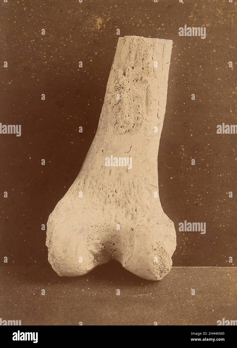 Unteres Ende des rechten Oberschenkels mit pulmonaler Osteo-Arthropathie betroffen (posteriore Ansicht) Stockfoto