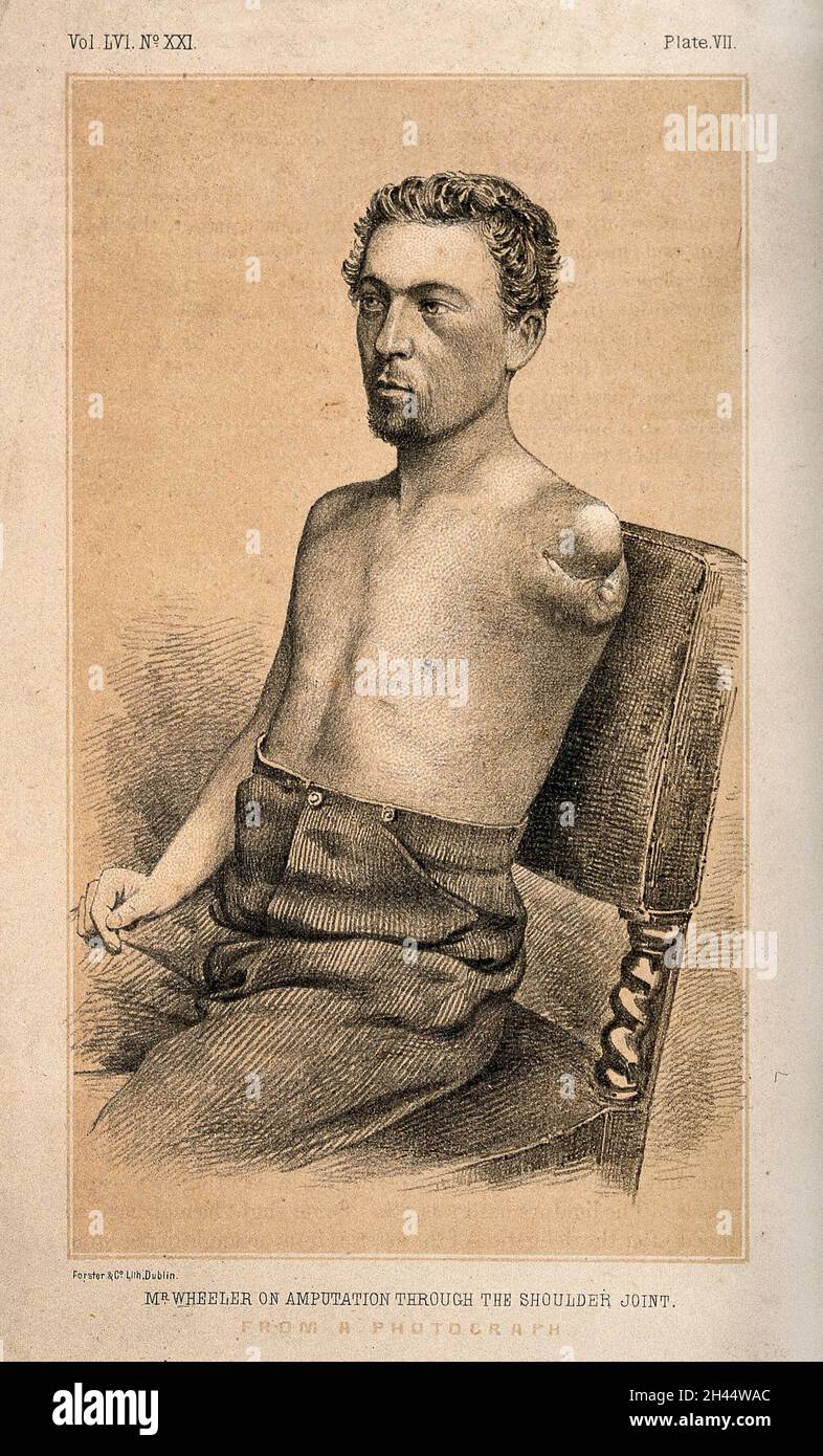 Ein Mann mit einem Arm, der von der Schulter amputiert wurde. Lithographische Wiedergabe. Stockfoto