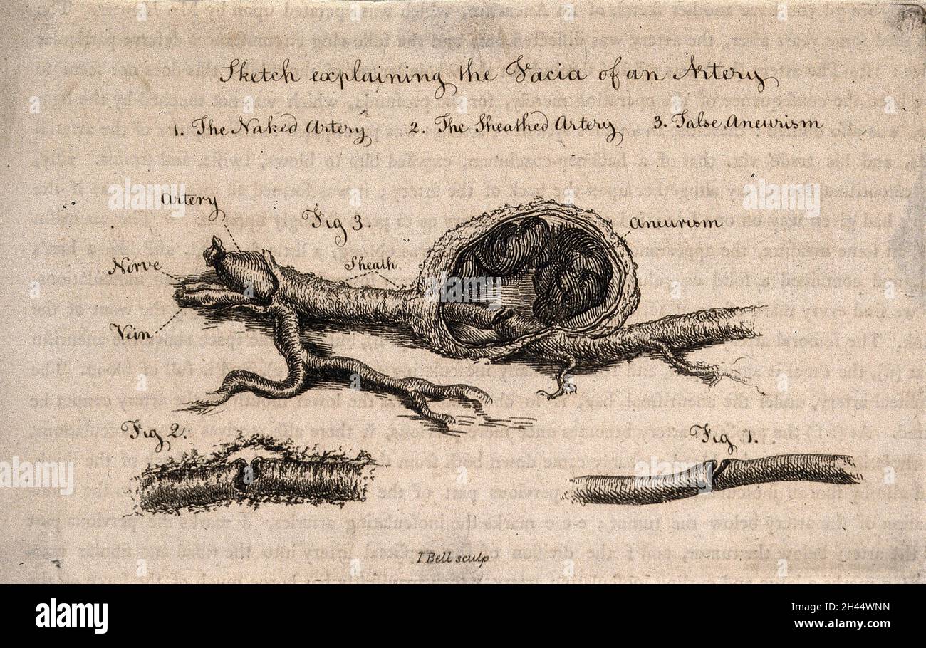 Drei Abschnitte einer dissektierten Arterie, nummeriert für den Schlüssel. Radierung von I. Bell, c. 1815 (?). Stockfoto