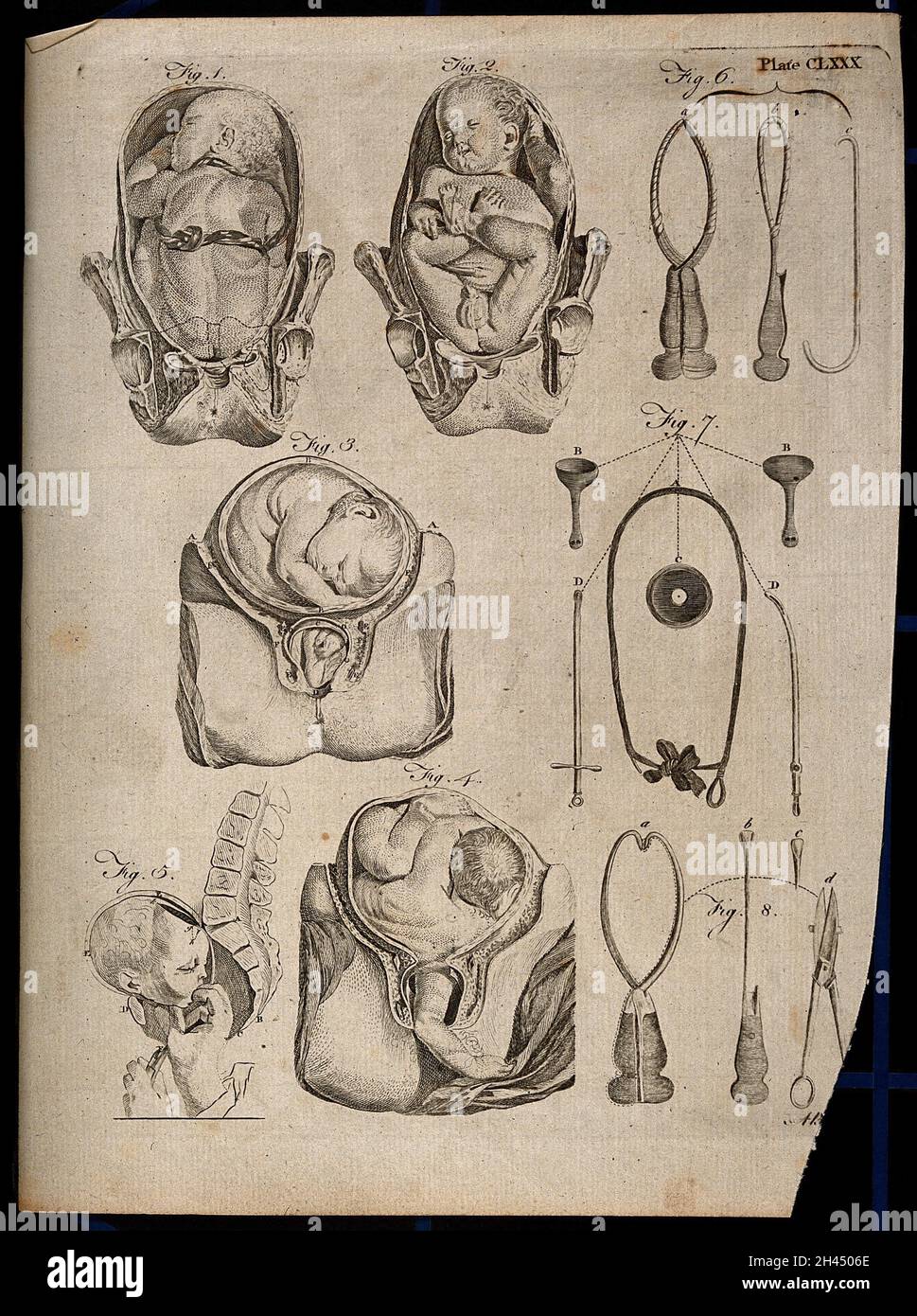 Acht Diagramme, die schwierige Geburten und geburtshilfliche Instrumente veranschaulichen. Stich von A. Bell. Stockfoto