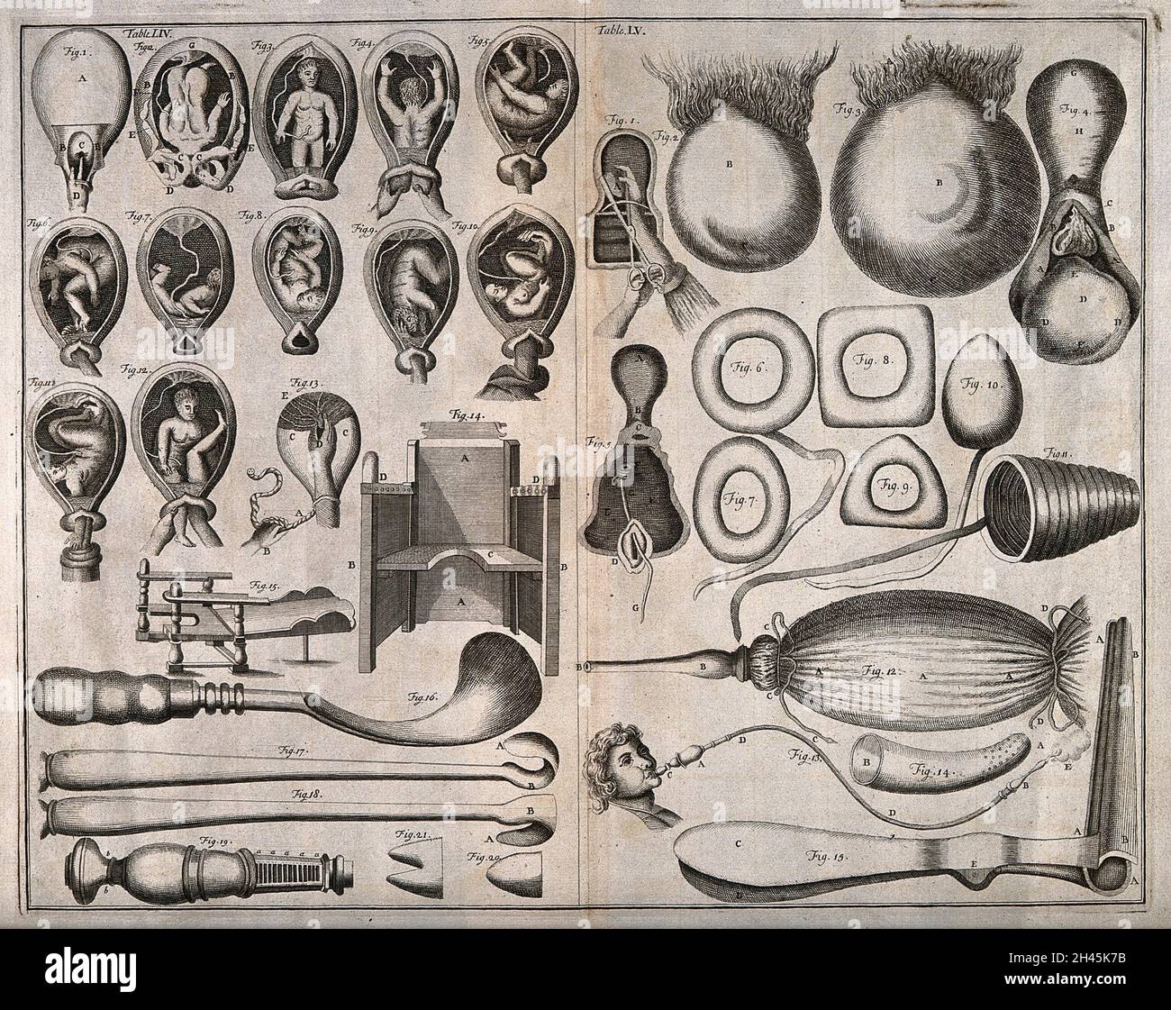 Links, verschiedene Methoden der Untersuchung des Uterus; rechts, Uteri mit Muttermalen und vorgebrochener Uteri. Gravur mit Radierung. Stockfoto