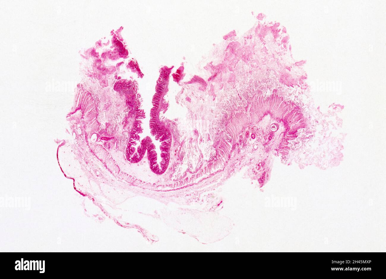 Amöbiasis: Dickdarm Stockfoto