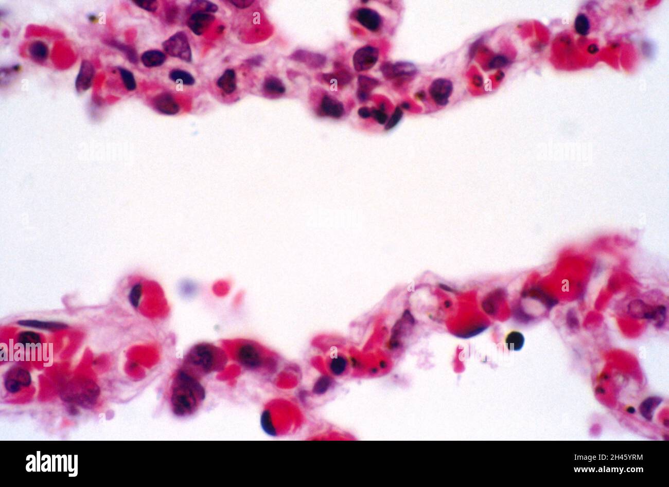 Plasmodium falciparum Malaria: Lunge Stockfoto