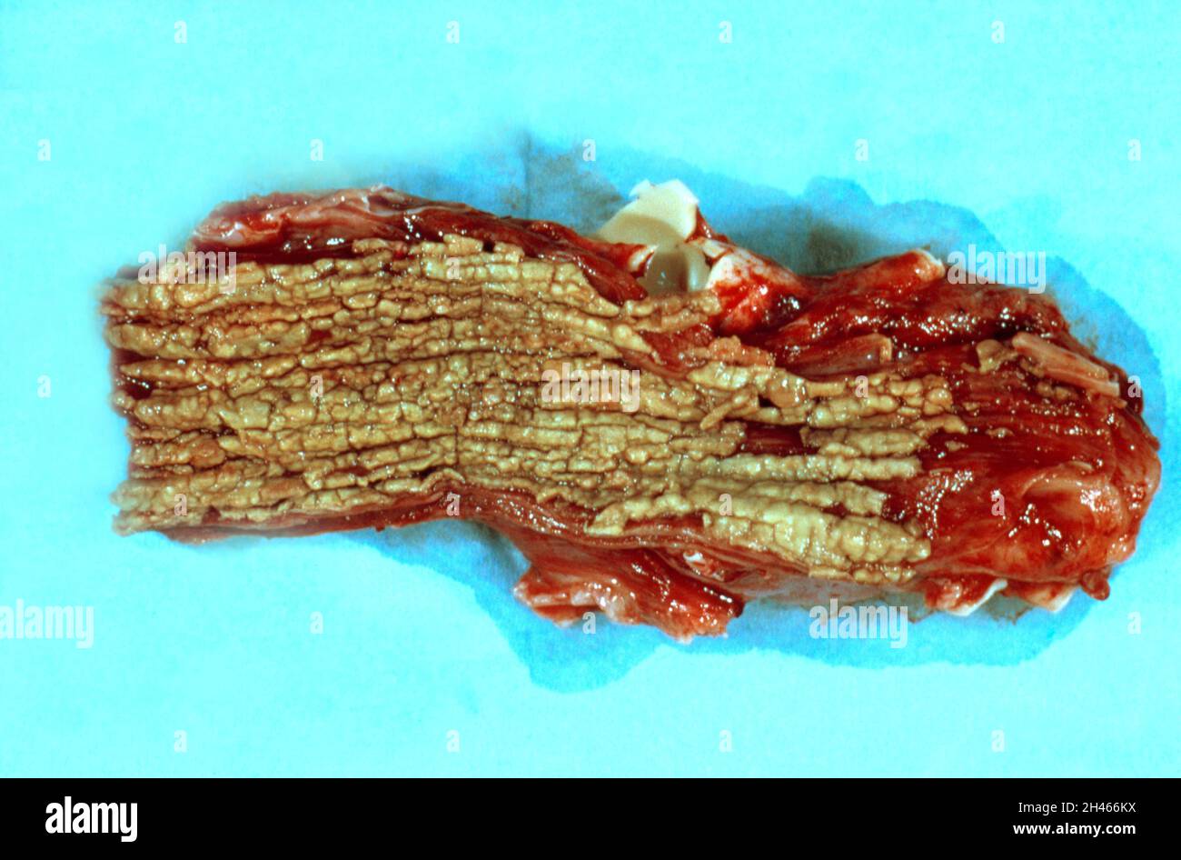 Speiseröhre: Ösophageale Candidiasis mit AIDS Stockfoto
