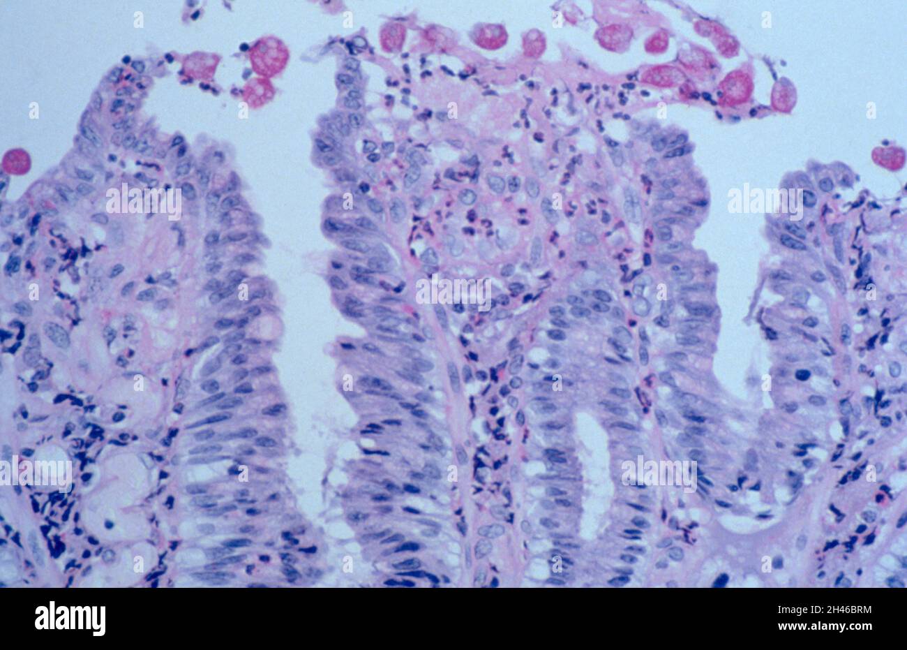 Amöbiasis: Histopathologie des Dickdarms Stockfoto