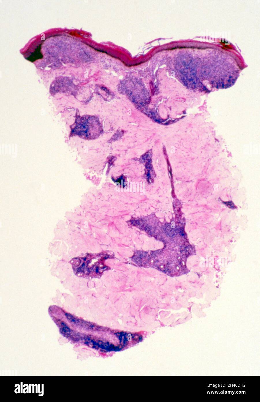 Lepra: Haut Stockfoto