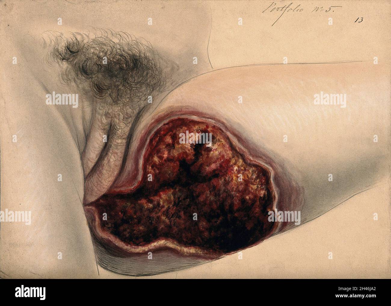 Schwer erkranktes Gewebe am inneren Oberschenkel einer Frau. Aquarell mit Kreide von C. D'Alton, 1866. Stockfoto