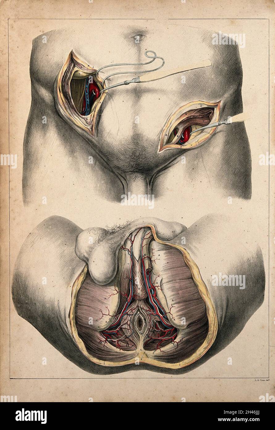 Operation der Arterien der Iliacus und des männlichen Perineums: Zwei Abbildungen mit Disektionen. Kolorierte Lithographie von G.E. Madeley nach A. A. Cane, 1834. Stockfoto Operation der Arterien der Iliacus und des männlichen Perineums: Zwei Abbildungen mit Disektionen. Kolorierte Lithographie von G.E. Madeley nach A. A. Cane, 1834. Stockfoto