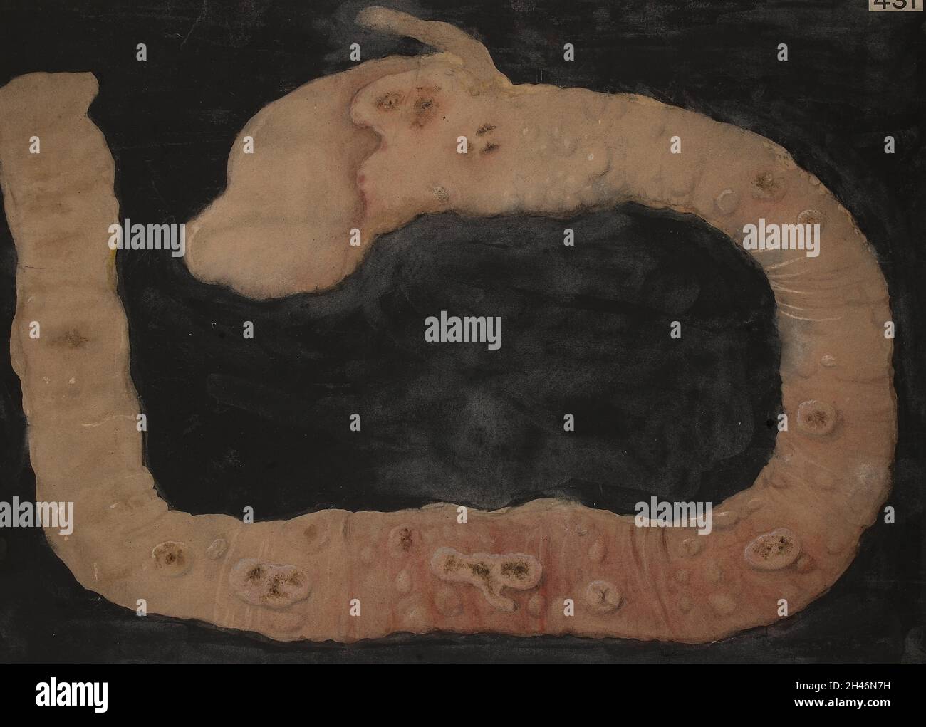 Typhus-Ulzeration des Dünndarms, in einem frühen Stadium der Krankheit Stockfoto